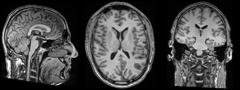 Actual T1 MRI cross-sections, left to right: sagittal, axial and coronal.